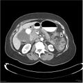 Acute pancreatitis (Radiopaedia 19136-19117 Axial C+ portal venous phase 17).jpg