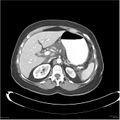 Acute pancreatitis (Radiopaedia 19136-19117 Axial C+ portal venous phase 8).jpg