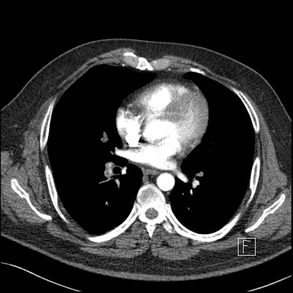 File:Acute pulmonary embolism with pulmonary infarct (Radiopaedia 73062-83768 Axial C+ CTPA 42).jpg