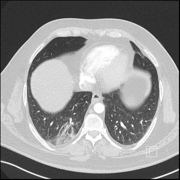 File:Acute pulmonary embolism with pulmonary infarct (Radiopaedia 73062-83768 Axial lung window 14).jpg