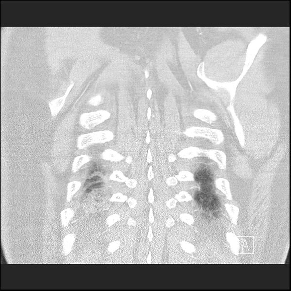 File:Acute pulmonary embolism with pulmonary infarct (Radiopaedia 73062-83768 Coronal lung window 70).jpg