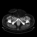 Acute pyelonephritis (Radiopaedia 25657-25837 Axial renal parenchymal phase 85).jpg