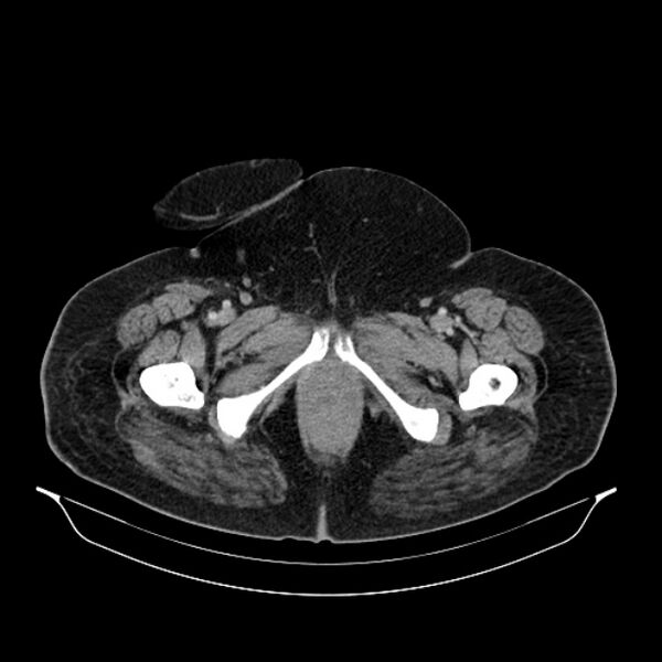 File:Acute pyelonephritis (Radiopaedia 25657-25837 Axial renal parenchymal phase 85).jpg