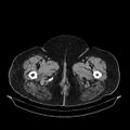 Acute pyelonephritis (Radiopaedia 25657-25837 Axial renal parenchymal phase 89).jpg