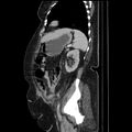 Acute pyelonephritis (Radiopaedia 25657-25837 Sagittal renal parenchymal phase 58).jpg
