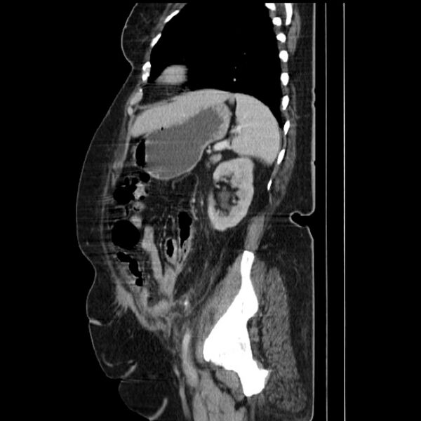 File:Acute pyelonephritis (Radiopaedia 25657-25837 Sagittal renal parenchymal phase 58).jpg