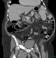 Acute renal failure post IV contrast injection- CT findings (Radiopaedia 47815-52559 Coronal C+ portal venous phase 9).jpg