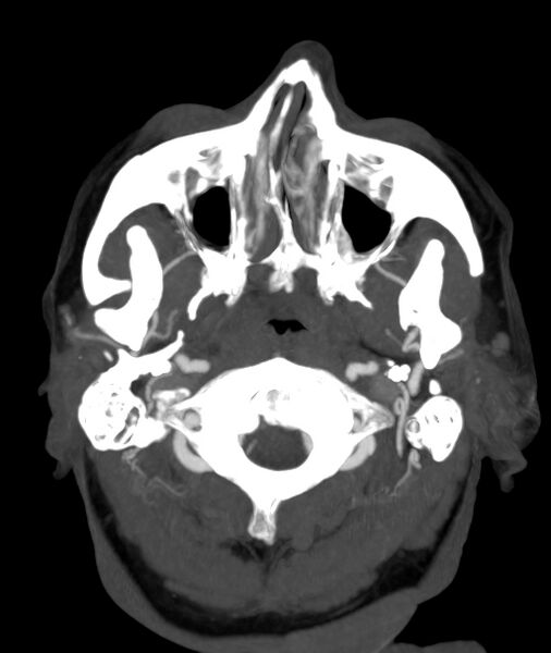 File:Acute right MCA M1 occlusion (Radiopaedia 62268-70454 Axial Phase 1 32).jpg