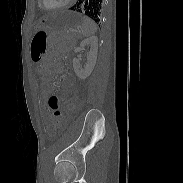 File:Acute vertebral body compression fractures (Radiopaedia 31757-32693 Sagittal bone window 1).jpg