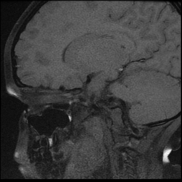 File:Adamantinomatous craniopharyngioma (Radiopaedia 77407-89529 Sagittal T1 fat sat 12).jpg