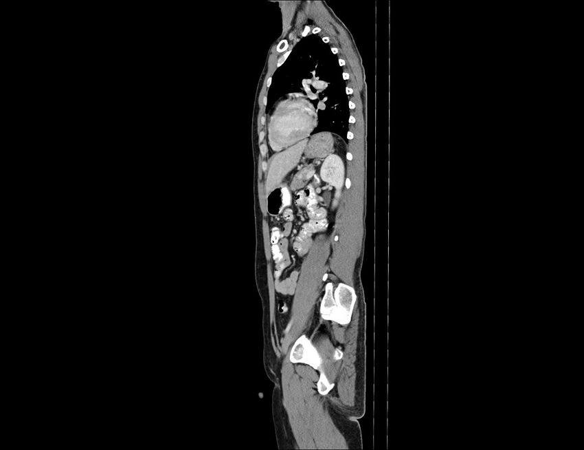 Addison disease (Radiopaedia 49318-54412 Sagittal C+ portal venous phase 24).jpg