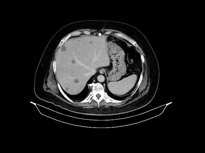 File:Adenocarcinoma of pancreas with hepatic metastasis (Radiopaedia 64332-73122 Axial C+ delayed 20).jpg