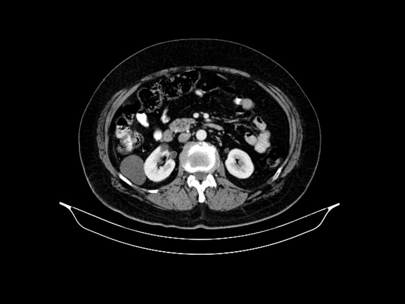 File:Adenocarcinoma of pancreas with hepatic metastasis (Radiopaedia 64332-73122 Axial C+ portal venous phase 46).jpg