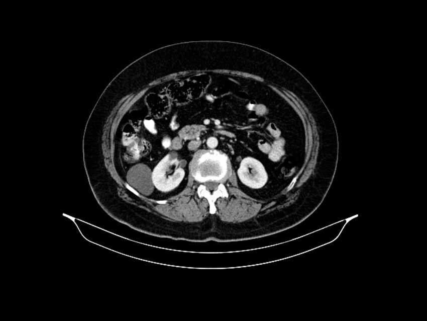 Adenocarcinoma of pancreas with hepatic metastasis (Radiopaedia 64332-73122 Axial C+ portal venous phase 46).jpg