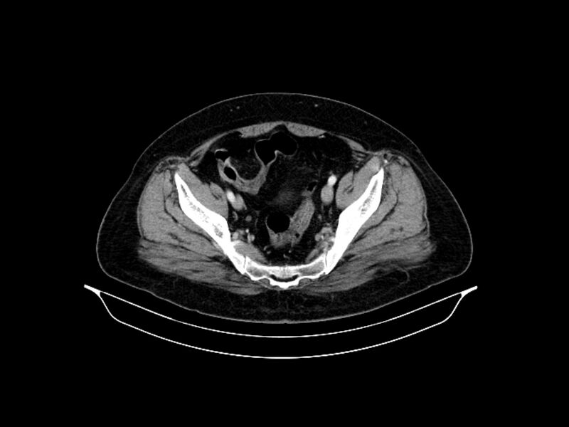 File:Adenocarcinoma of pancreas with hepatic metastasis (Radiopaedia 64332-73122 Axial C+ portal venous phase 86).jpg