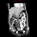 Adenocarcinoma of the colon (Radiopaedia 8191-9039 Coronal liver window 13).jpg