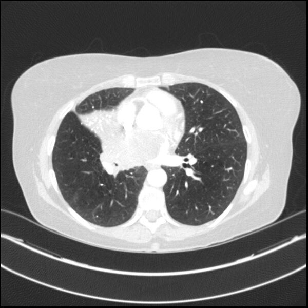 File:Adenocarcinoma of the lung (Radiopaedia 44205-47803 Axial lung window 53).jpg