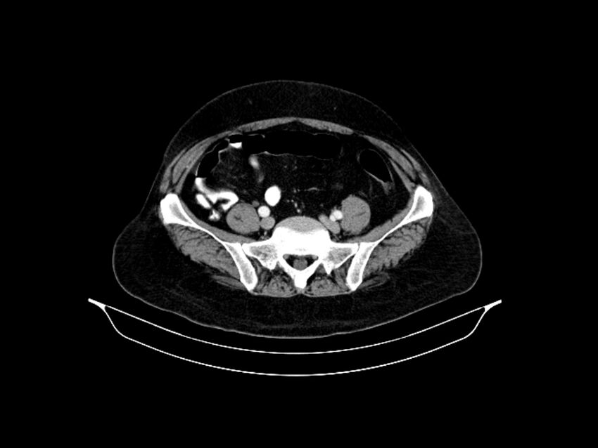 Adenocarcinoma of the lung (Radiopaedia 44205-47803 Sagittal C+ portal venous phase 2).jpg