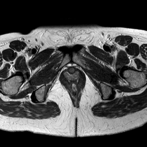 File:Adenomyoma of the uterus (Radiopaedia 9871-10439 Axial T2 2).jpg