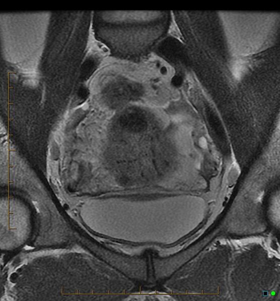 File:Adenomyosis uterus with hematometra (Radiopaedia 45779-50011 Coronal T2 5).jpg