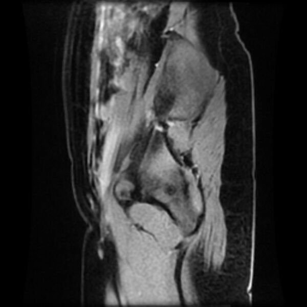 File:Adenomyosis within a septate uterus (Radiopaedia 69963-79981 Sagittal LAVA-Dyn 1).jpg