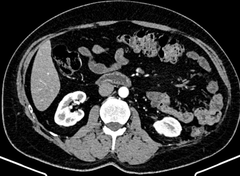 File:Adrenal metastases (Radiopaedia 73082-83791 Axial C+ arterial phase 84).jpg