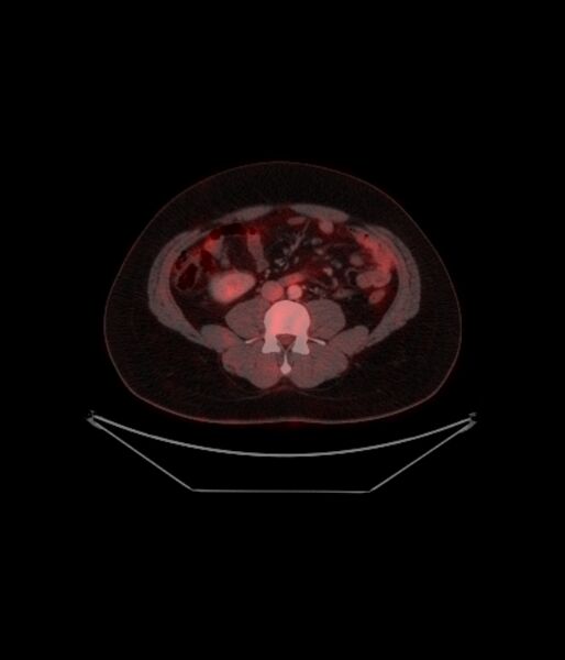 File:Adrenocortical carcinoma (Radiopaedia 80134-93440 ِAxial 197).jpg