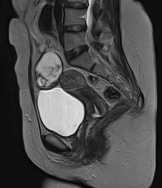 File:Adult granulosa cell tumor of the ovary (Radiopaedia 71581-81950 Sagittal T2 13).jpg