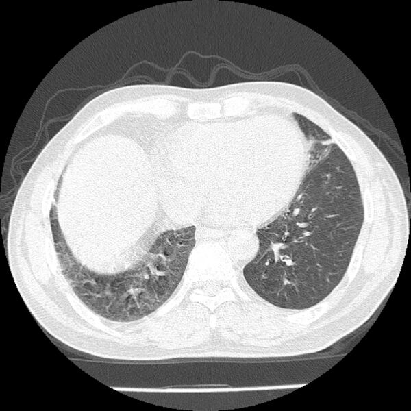 File:Airway foreign body in adult (Radiopaedia 85907-101779 Axial lung window 133).jpg