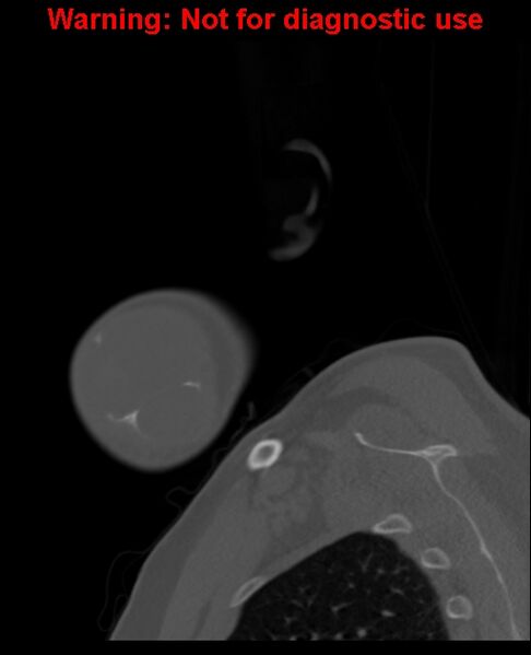 File:Ameloblastoma (Radiopaedia 33126-34164 Sagittal bone window 10).jpg