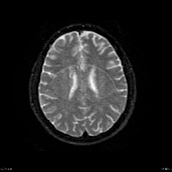 File:Amnestic syndrome secondary to hypoxic brain injury (Radiopaedia 24743-25004 DWI 52).jpg
