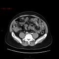 Ampullary carcinoma (Radiopaedia 56396-63056 B 51).jpg