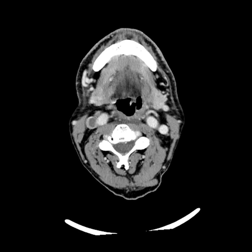 Anaplastic thyroid carcinoma (Radiopaedia 79087-92034 B 79).jpg