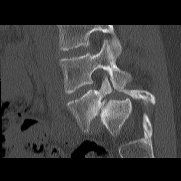 File:Anterolisthesis (Radiopaedia 22226-22263 Sagittal bone window 6).jpg