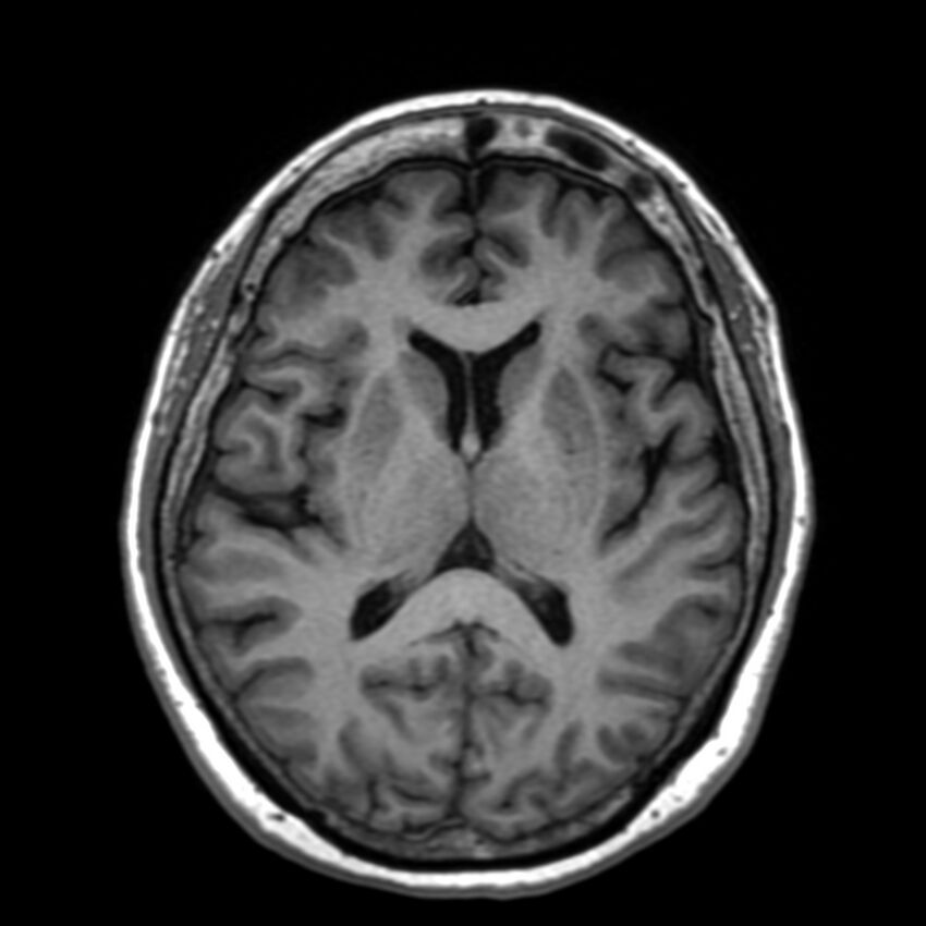 Anti-MOG encephalomyelitis (Radiopaedia 73831-84646 Axial T1 28).jpg
