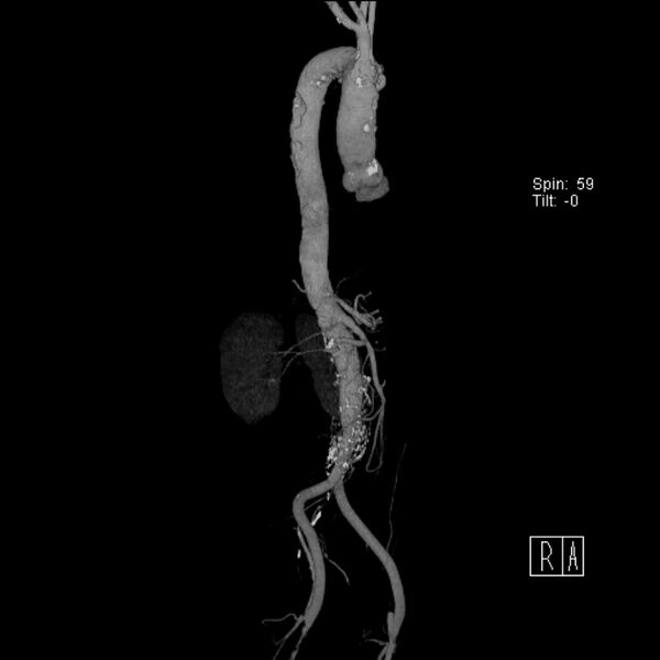 File:Aortic arch saccular aneurysm (Radiopaedia 19430-19457 A 16).jpg