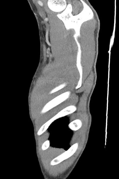 File:Aortic coarctation with aneurysm (Radiopaedia 74818-85828 B 16).jpg