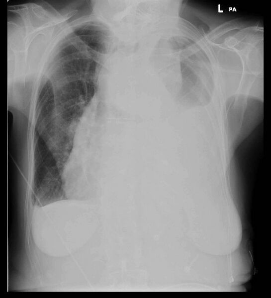 File:Aortic dissection (Radiopaedia 68763-78475 Frontal 1).jpeg