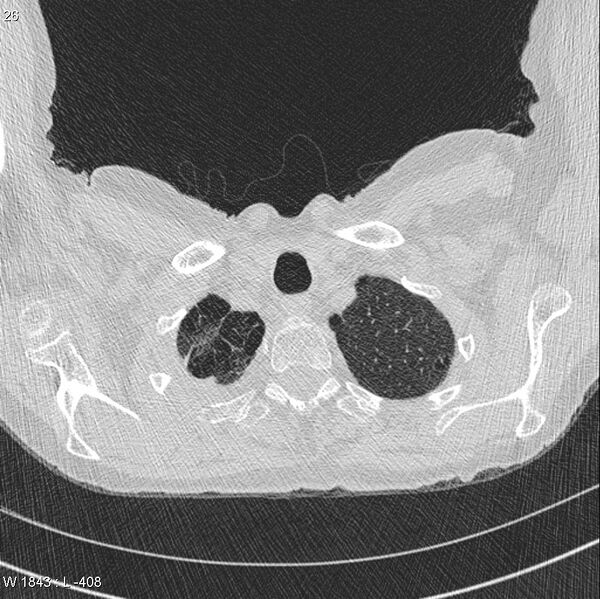 File:Apical non-small-cell lung cancer (Radiopaedia 8570-9405 Axial lung window 3).jpg
