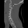 Apical pneumothorax on cervical spine CT (Radiopaedia 45343-49368 Sagittal bone window 9).jpg