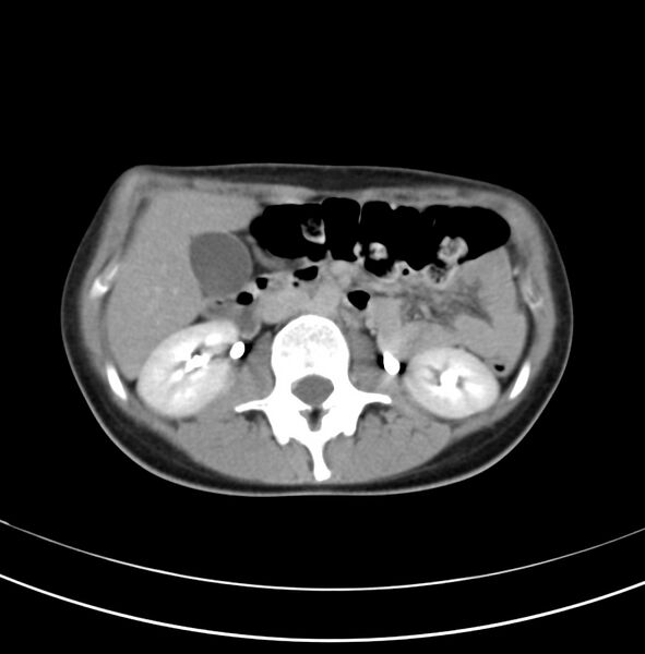 File:Appendicitis and incidental bicornuate uterus (Radiopaedia 22833-22853 Axial C+ delayed 12).jpg