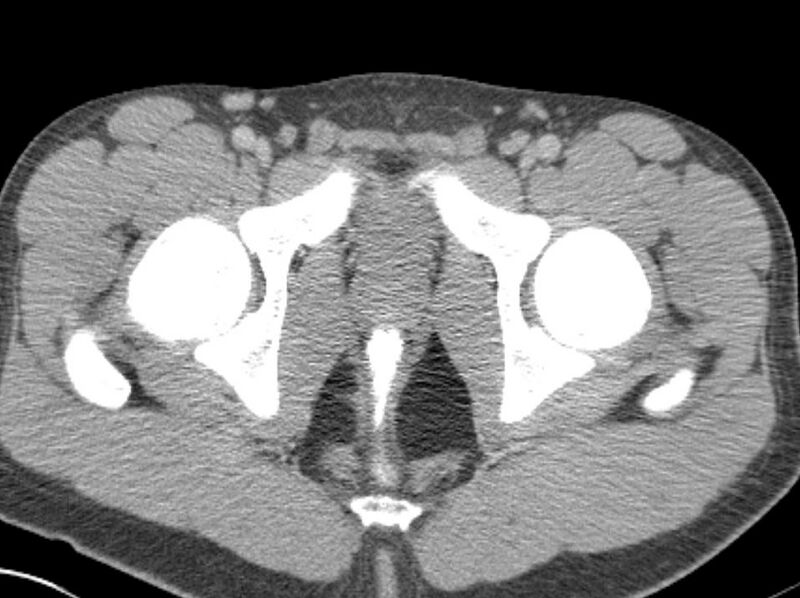 File:Appendicitis and incidental foregut duplication cyst (Radiopaedia 52962-58916 A 103).jpg