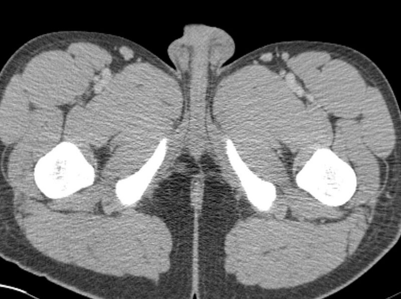 File:Appendicitis and incidental foregut duplication cyst (Radiopaedia 52962-58916 A 120).jpg