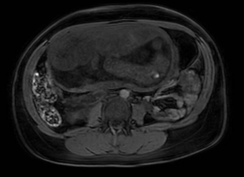 File:Appendicitis in gravida (MRI) (Radiopaedia 89433-106395 Axial DIXON 70).jpg
