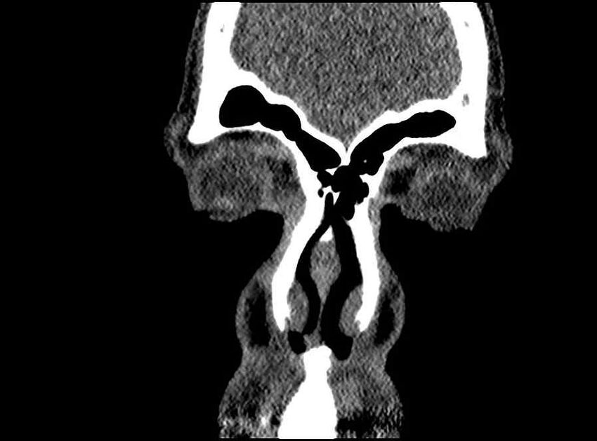 Arachnoid cyst- extremely large (Radiopaedia 68741-78450 Coronal bone window 71).jpg