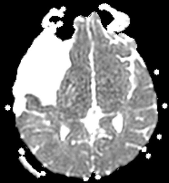 File:Arachnoid cyst- extremely large (Radiopaedia 68741-78451 Axial ADC 12).jpg