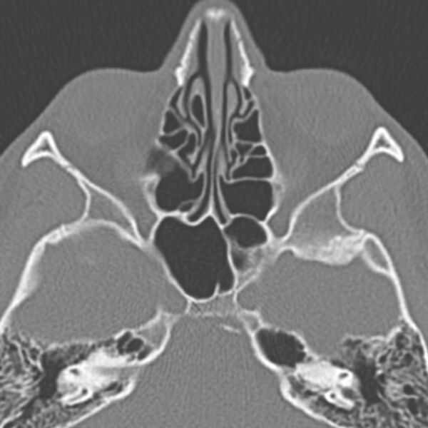 File:Arrested pneumatization of the sphenoid (Radiopaedia 10700-11172 Axial non-contrast 2).jpg