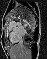 Arrhythmogenic right ventricular cardiomyopathy (Radiopaedia 57972-64966 D 2).jpg
