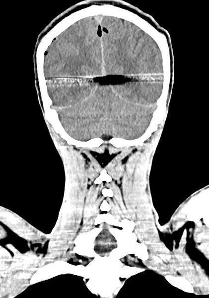 File:Arrow injury to the brain (Radiopaedia 72101-82607 Coronal non-contrast 57).jpg