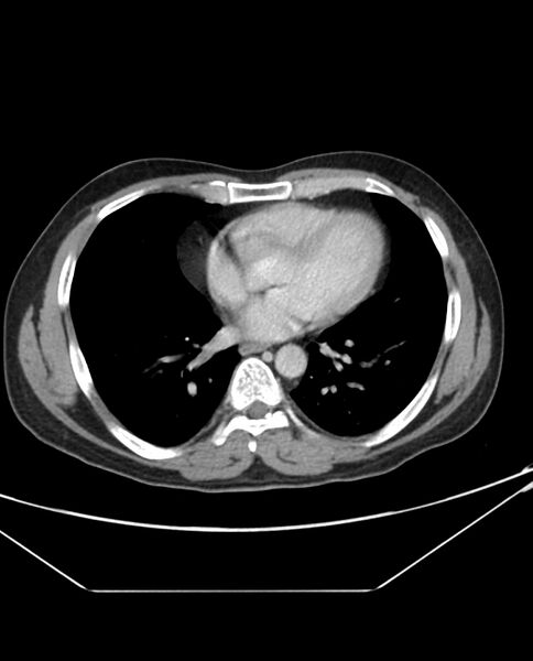 File:Arterial occlusive mesenteric ischemia (Radiopaedia 84641-100054 A 1).jpg